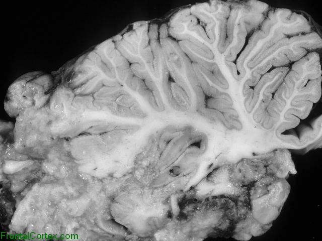 Organizing Infarct, sagittal section of cerebellum